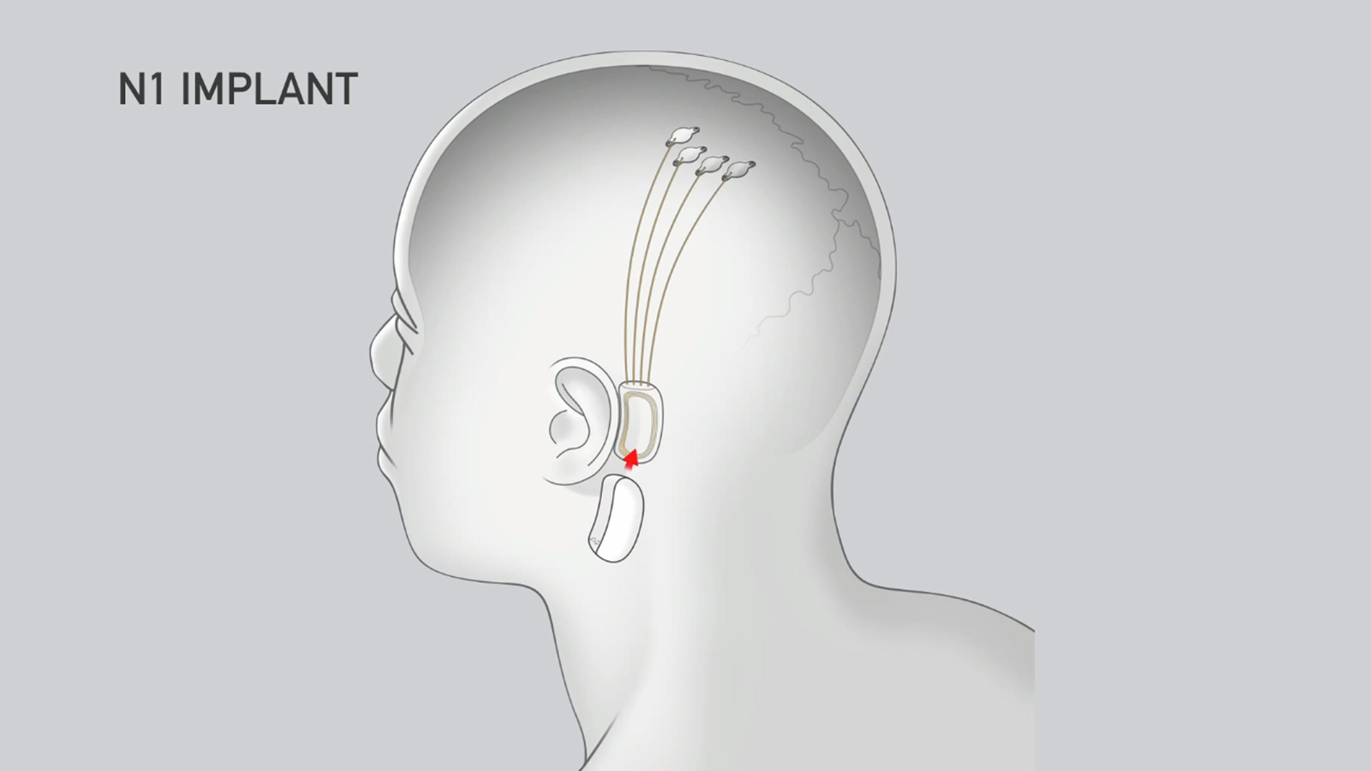 Elon Musk Details Neuralink Brain Interface Tech, Oculus CTO Calls